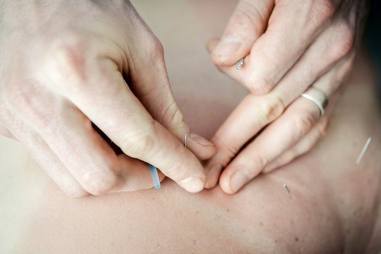 Acupuncturist Hands II