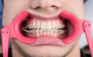 Macro shot of white teeth with braces and dental retractor at the dental office. Orthodontic...
