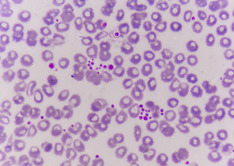 platelet clumping as a possible cause of low platelet count in patients.