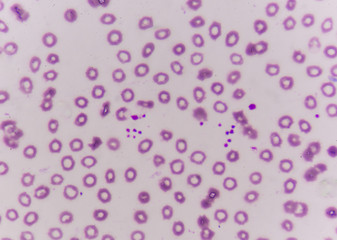 platelet clumping as a possible cause of low platelet count in patients.