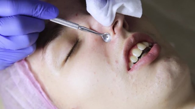 beautician squeezing pimple blackheads from nose with pimple popper tool