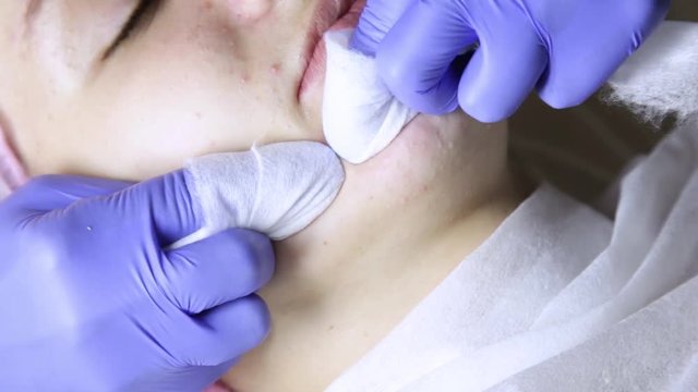 beautician squeezing pimple blackheads for young wonan in beauty salon. facial skin care