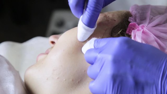 Squeezing pimple acne treatments. Young woman receiving beauty face therapy of cleaning pimple.