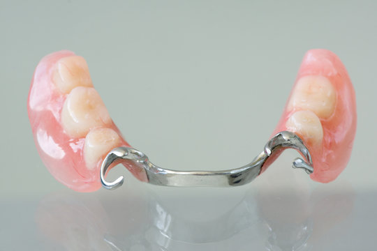 Clasp denture with a metal arc