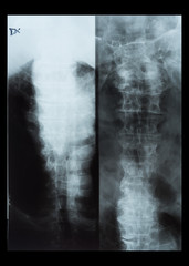 X-Ray of human spinal column