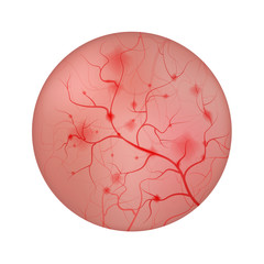 Inflammation of the urinary bladder Cystitis, interior lining closeup illustration