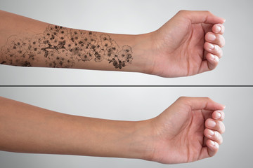 Woman's Hand Before And After Laser Tattoo Removal