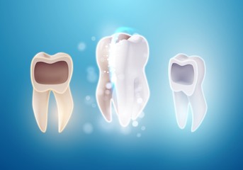 Illustration of 3D Realistic Vector Teeth Cleaning Process. Vector Tooth Cleaning Treatment. Healthcare Stomatology Procedure