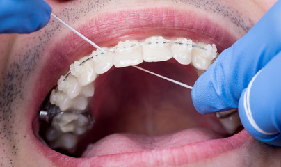 Dentist cleaning teeth with ceramic brackets, using floss at the dental office. Macro shot of teeth...