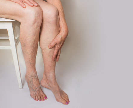 Varicose Veins On A Female Legs