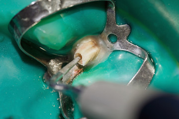 opening of the tooth canal