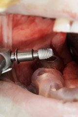 small dental implant for the eighth tooth