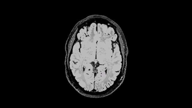 MRI brain scan,magnetic resonance imaging of a brain, ultra hd 4k, time lapse