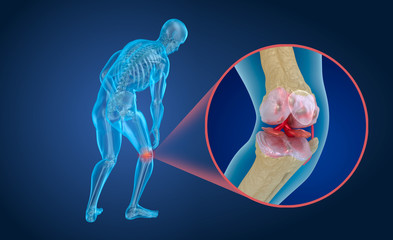 Osteoporosis of the knee joint,  Medically accurate 3D illustration