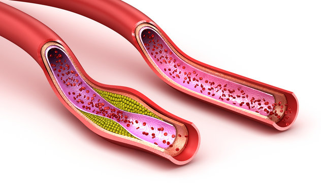 Blood Vessel : Normal And Cholesterol Damaged Vessel . 3D Render