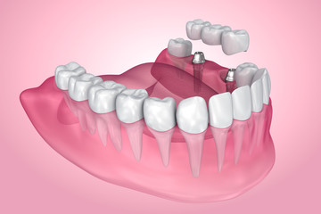 implant supported fixed bridge. Transparent view . Medically accurate 3D illustration