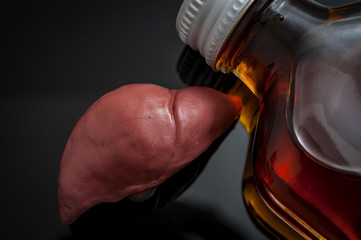 Alcoholic liver damage and cirrhosis concept with a liver next to a flask of alcohol. Cirrhosis is...