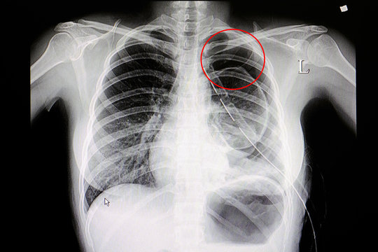 Chest x-ray film of patient with Pneumothorax