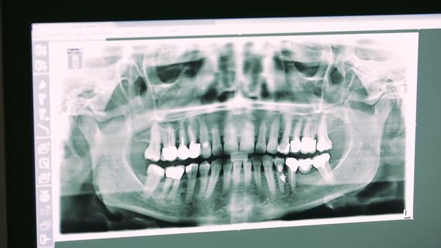 Tooth implant on X-ray picture