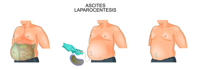 a man suffering from ascites. Laparocentesis