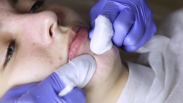 beautician squeezing pimple blackheads for young wonan in beauty salon. facial skin care