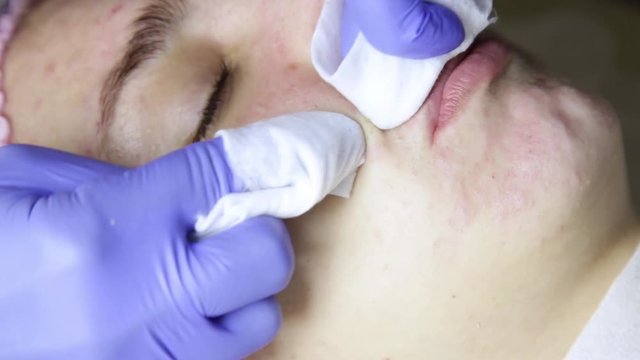 beautician squeezing pimple blackheads for young wonan in beauty salon. facial skin care
