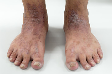 Atopic dermatitis (AD), also known as atopic eczema, is a type of inflammation of the skin (dermatitis) at foot.