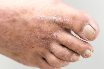 Atopic dermatitis (AD), also known as atopic eczema, is a type of inflammation of the skin...
