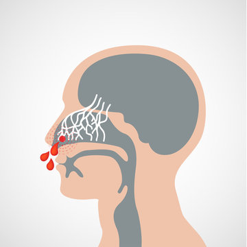 Epistaxis vector logo icon illustration