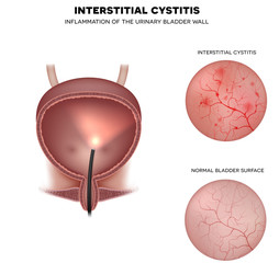 Urinary bladder lining, examination with Cystoscope closeup of healthy lining and unhealthy cystitis