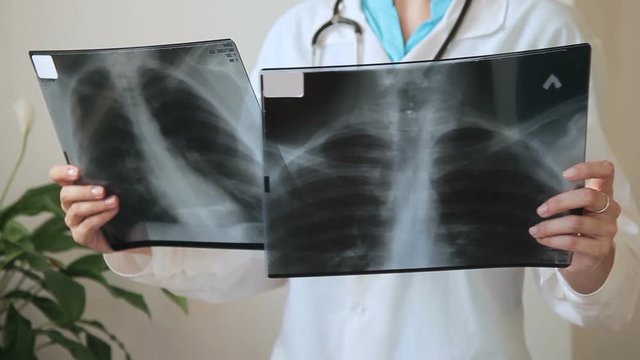 Doctor at clinic to compare two X-ray picture of human thorax. Medic with stethoscope holds before itself in hands flyuoragrafy series to assign correct treatment.