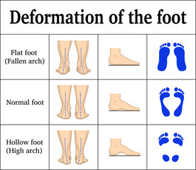 Deformation of the foot