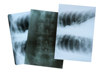 Three X-rays isolated on a white background. Roentgenogram of the lungs and  lumbar spine. Diagnostic methods. 8 November World Radiography Day.