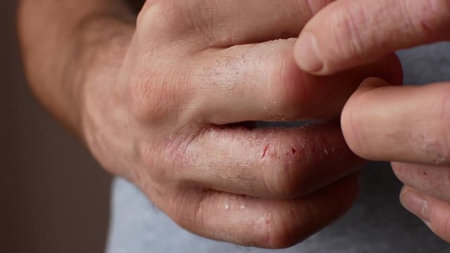 The man scratches his hands. Very itchy fingers, psoriasis.