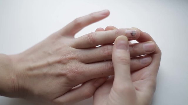 A bruise on the sick nail. Factory accident. Unhealthy damaged finger nail. Girl checks abnormality of the fingernail on a white background. The process of providing self-care in case of domestic