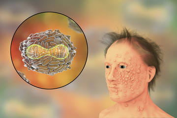 A man with smallpox infection and variola virus, a virus from Orthopoxviridae family that causes smallpox, highly contagious disease eradicated by vaccination, 3D illustration - obrazy, fototapety, plakaty