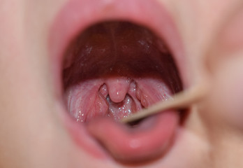 angina throat examination