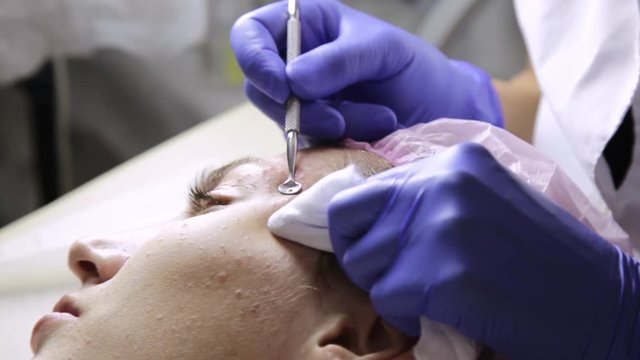 beautician squeezing pimple blackheads for young wonan in beauty salon. facial skin care