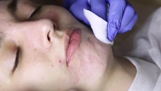 beautician squeezing pimple blackheads for young wonan in beauty salon. facial skin care