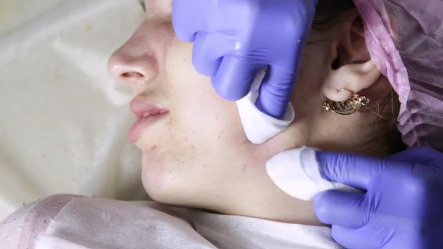 beautician squeezing pimple blackheads for young wonan in beauty salon. facial skin care