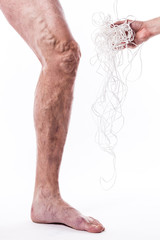 a tangle of ropes with a man being ill with varicose veins of the lower extremities and venous thrombophlebitis and on a white background, with depth of field Photo