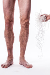a tangle of ropes with a man being ill with varicose veins of the lower extremities and venous thrombophlebitis and on a white background, with depth of field Photo