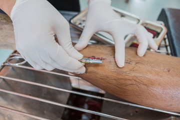 The wound stitched  in the leg  by doctor in the hospital. Accidental wounds .