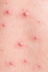 Fototapeta premium Chicken pox rash