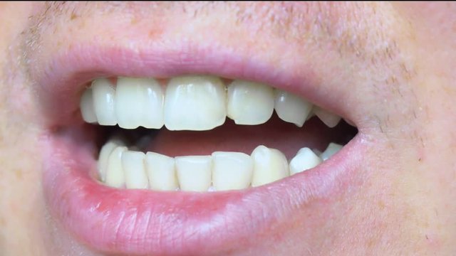 Teeth close-up, chipped teeth