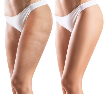 Woman legs before and after treatment skin.