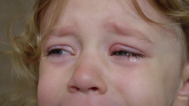 inflammation of the eye, the baby is crying