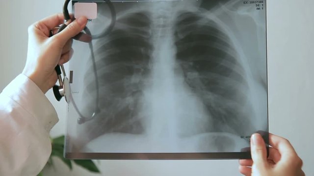 Doctor in clinic in hands holding an x-ray picture of human chest. Medical worker with a stethoscope examines results of fluorography examination.
