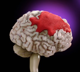 Illustration of human brain hemorrhage against black background