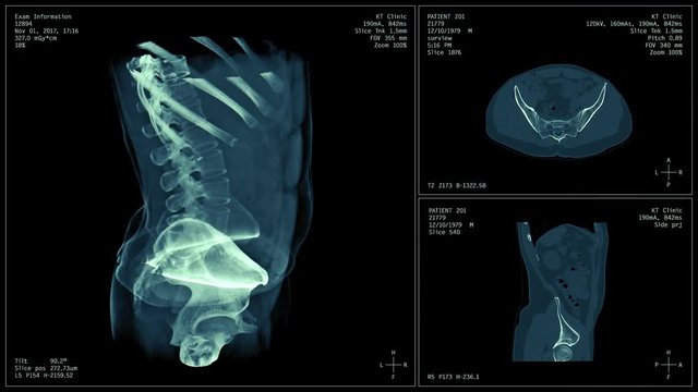 Body CT scan image, radiography x-ray examination, MRI tomography seamlessly looped animation, 3d visualization of real body computed tomography scanning with info-graphics.